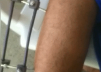 VÍDEO – Irmã de paciente que aguarda cirurgia no HGL há quase 40 dias pede socorro para irmão não ter perna amputada