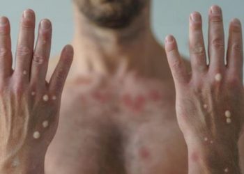 ES chega a cinco casos confirmados de varíola dos macacos