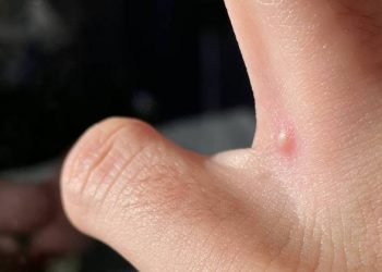 Secretaria de Saúde registra primeiro caso da varíola dos macacos em Linhares