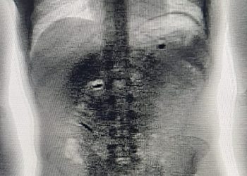 Suposta “droga” em estômago de homem: correria e surpresa na PRF em Linhares