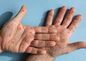 Mpox: Espírito Santo registra 48 casos da doença que preocupa a OMS