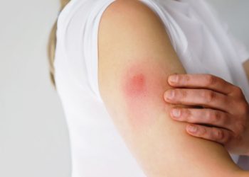 Oito casos de sarna humana são registrados em escola rural de São Mateus