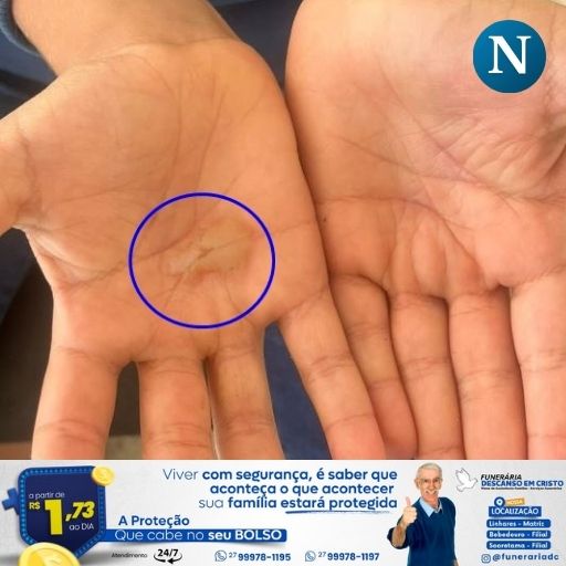 Mãe é presa após confessar que queimou as mãos do próprio filho com colher quente como castigo em Sooretama